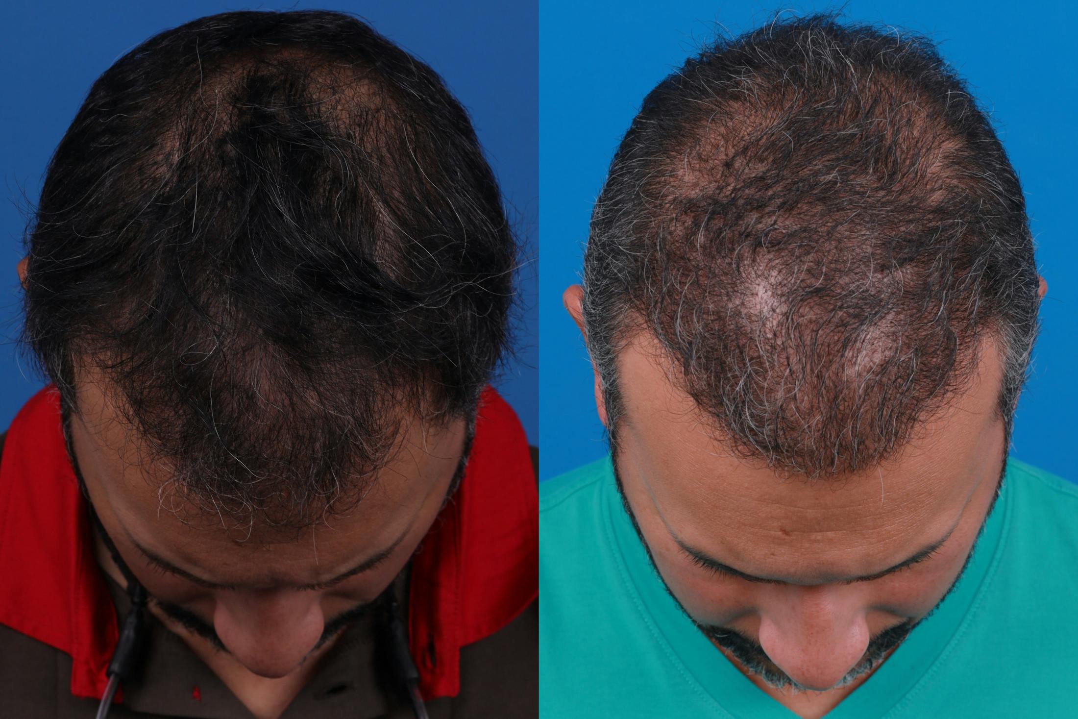 Hair Restoration Before & After Gallery - Patient 122405307 - Image 2