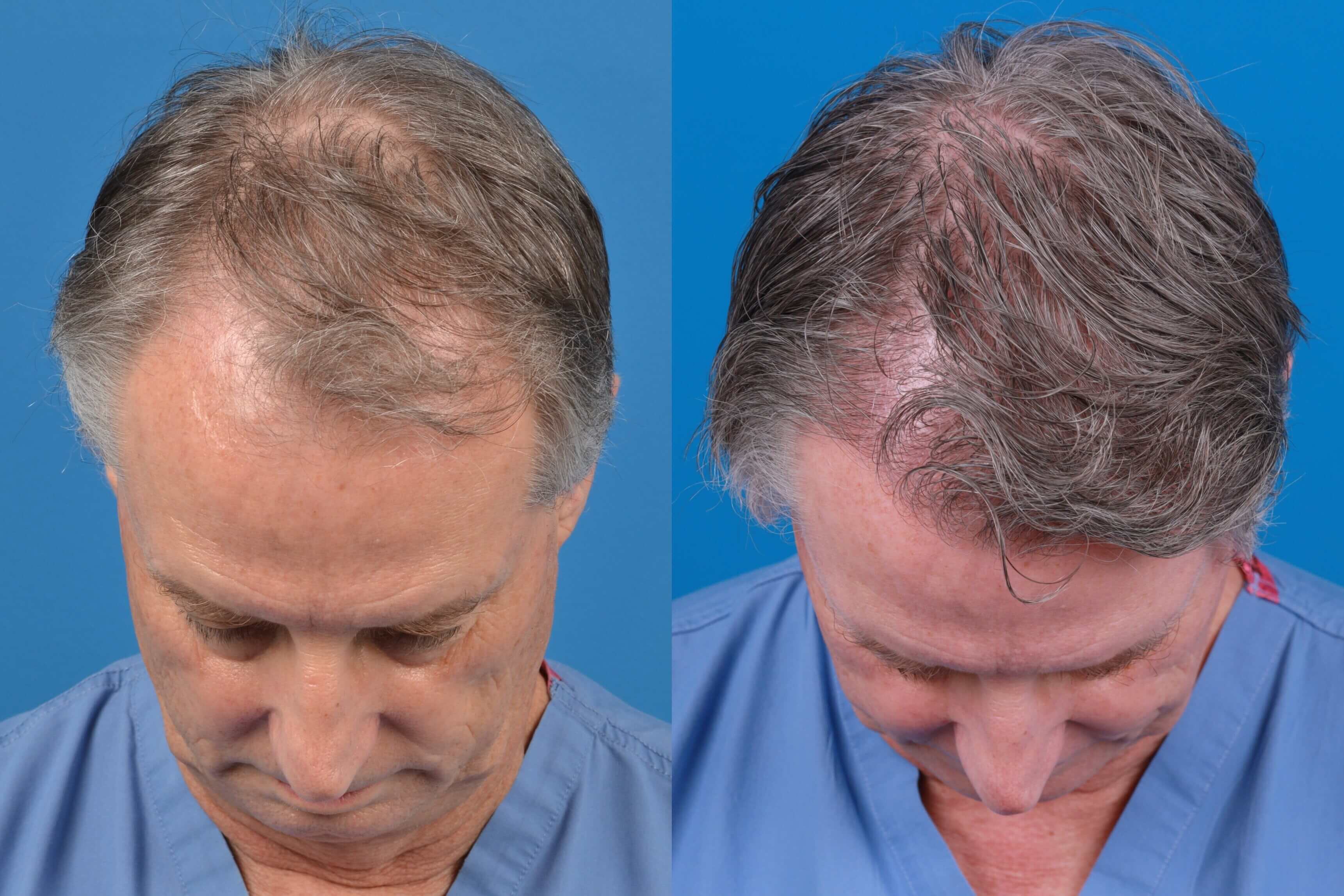 Hair Restoration Before & After Gallery - Patient 122405309 - Image 1