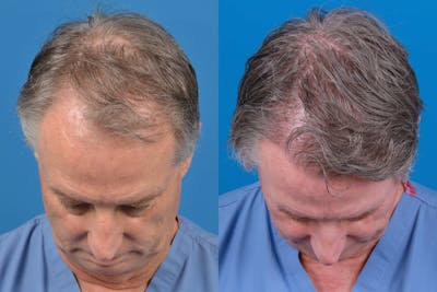 Hair Restoration Before & After Gallery - Patient 122405309 - Image 1