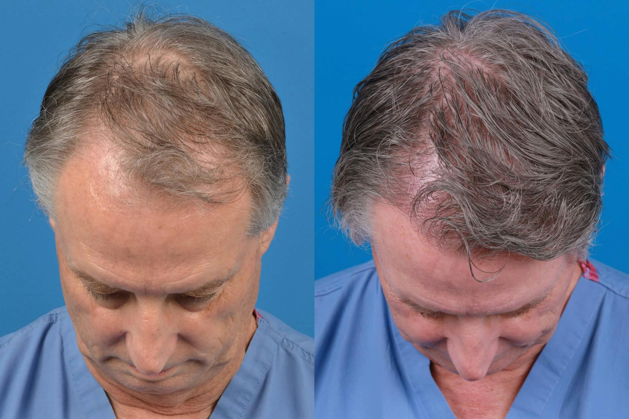 Hair Restoration Before & After Gallery - Patient 122405309 - Image 1