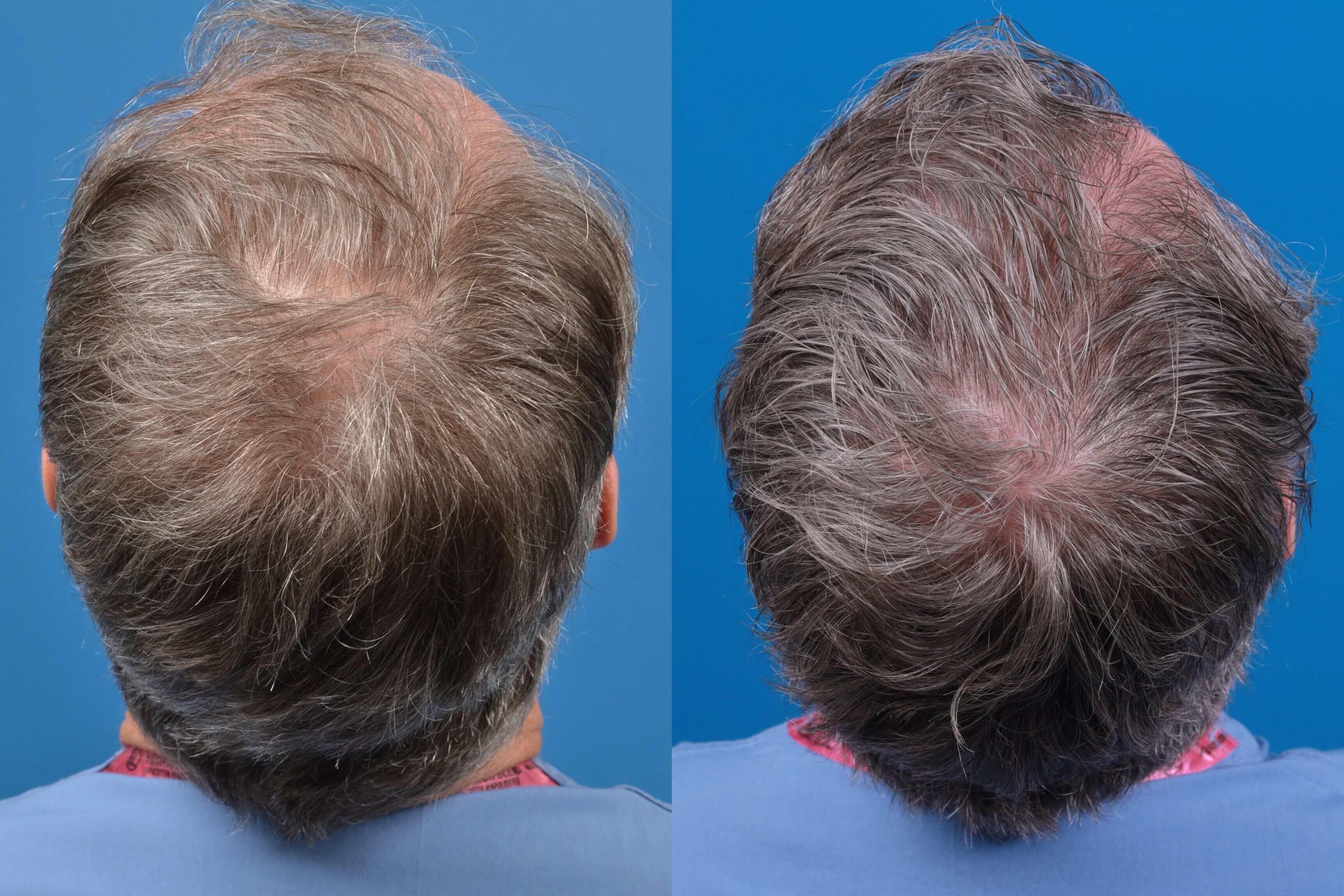 Hair Restoration Before & After Gallery - Patient 122405309 - Image 2