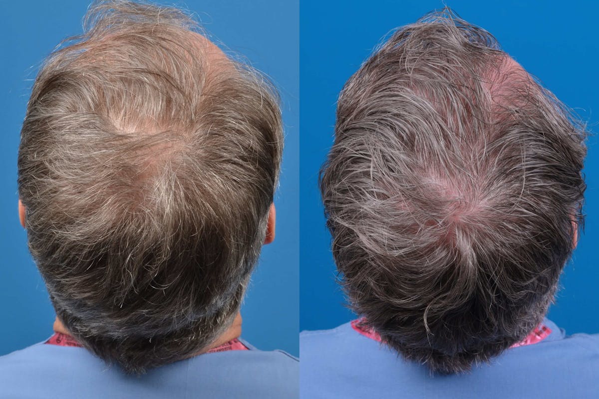 Hair Restoration Before & After Gallery - Patient 122405309 - Image 2