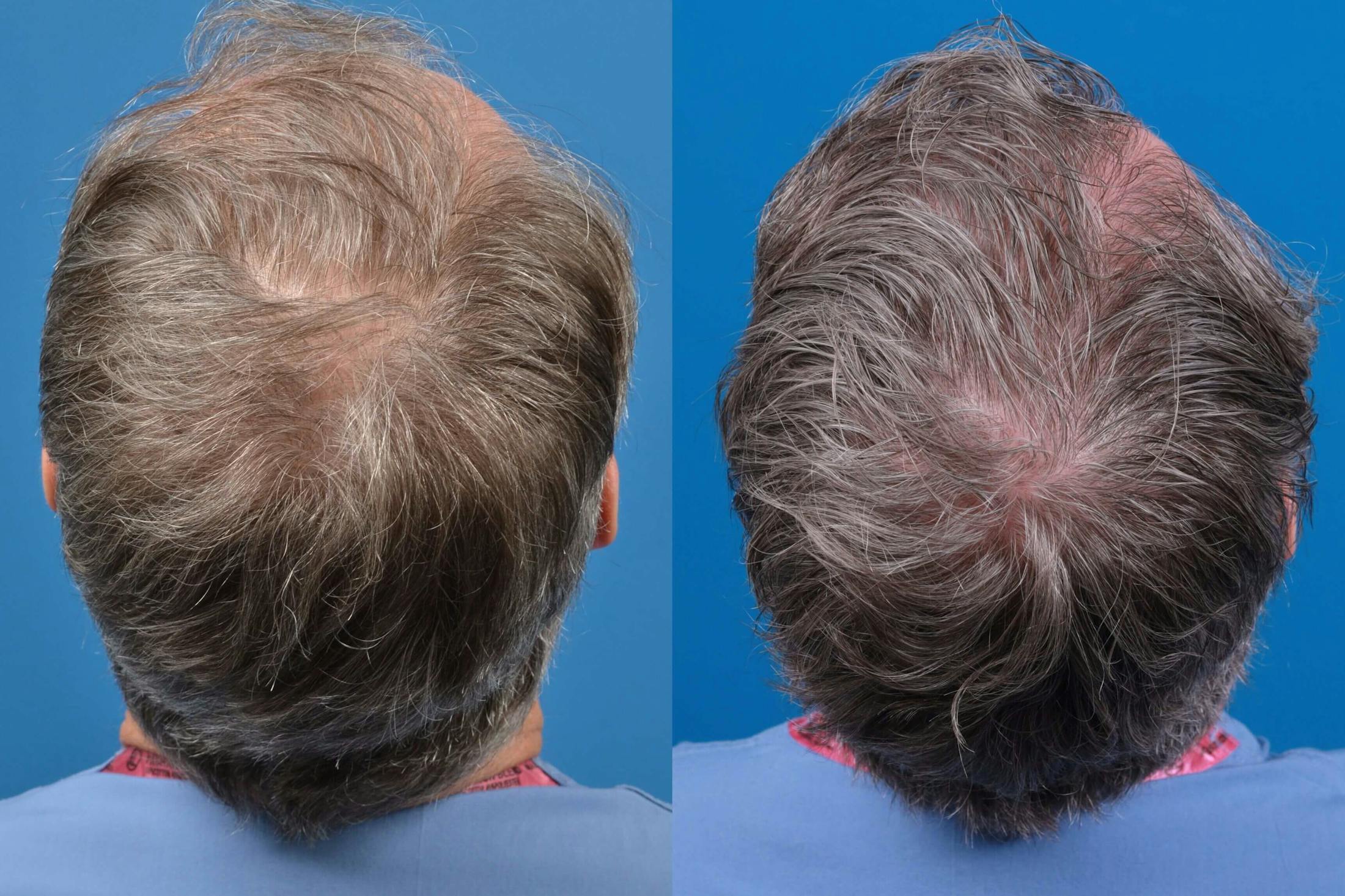 Hair Restoration Before & After Gallery - Patient 122405309 - Image 2