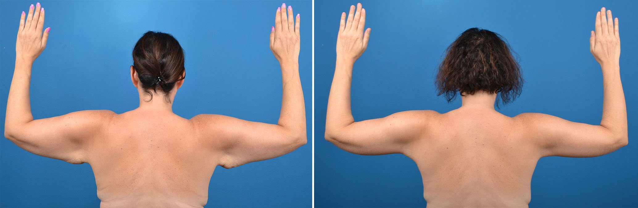 Hidden Arm Lift Before & After Gallery - Patient 302119 - Image 1