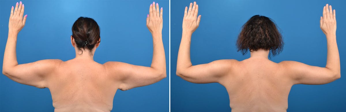 Arm Lift Before & After Gallery - Patient 382290 - Image 1