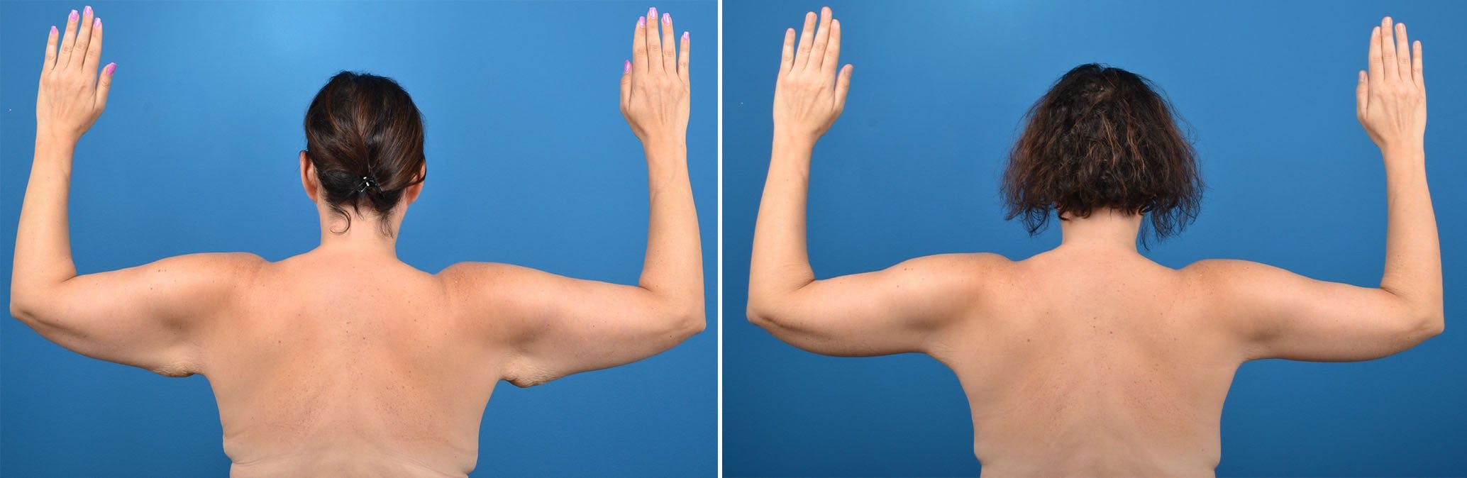 Arm Lift Before & After Gallery - Patient 122405364 - Image 1