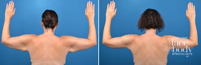 Hidden Thigh Lift Before & After Gallery - Patient 654549 - Image 1