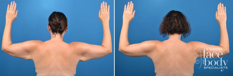 Hidden Arm Lift Before & After Gallery - Patient 302119 - Image 1