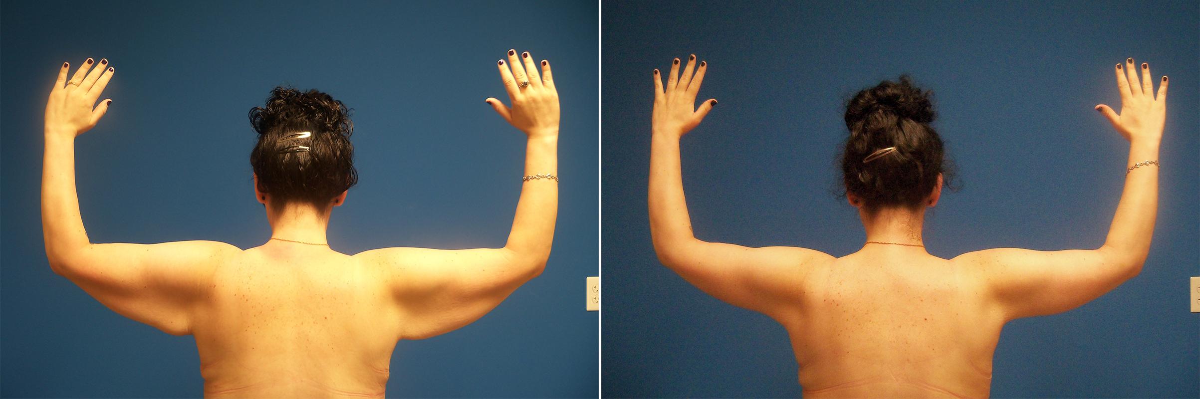 Hidden Arm Lift Before & After Gallery - Patient 332016 - Image 1