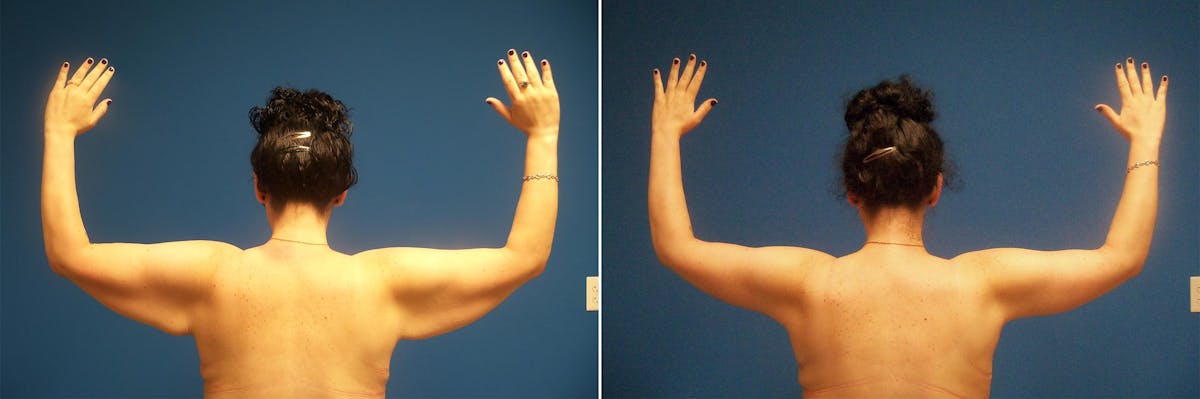 Arm Lift Before & After Gallery - Patient 900845 - Image 1