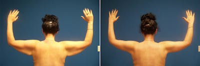 Hidden Arm Lift Before & After Gallery - Patient 332016 - Image 1