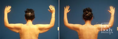 Hidden Thigh Lift Before & After Gallery - Patient 394023 - Image 1