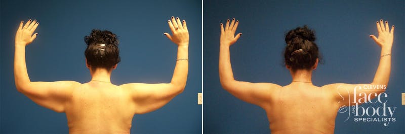 Hidden Arm Lift Before & After Gallery - Patient 332016 - Image 1