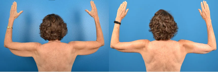 Hidden Arm Lift Before & After Gallery - Patient 627405 - Image 1