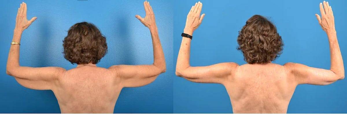 Arm Lift Before & After Gallery - Patient 296056 - Image 1
