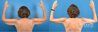 Hidden Thigh Lift Before & After Gallery - Patient 335068 - Image 1