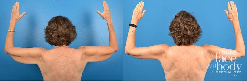 Hidden Arm Lift Before & After Gallery - Patient 627405 - Image 1