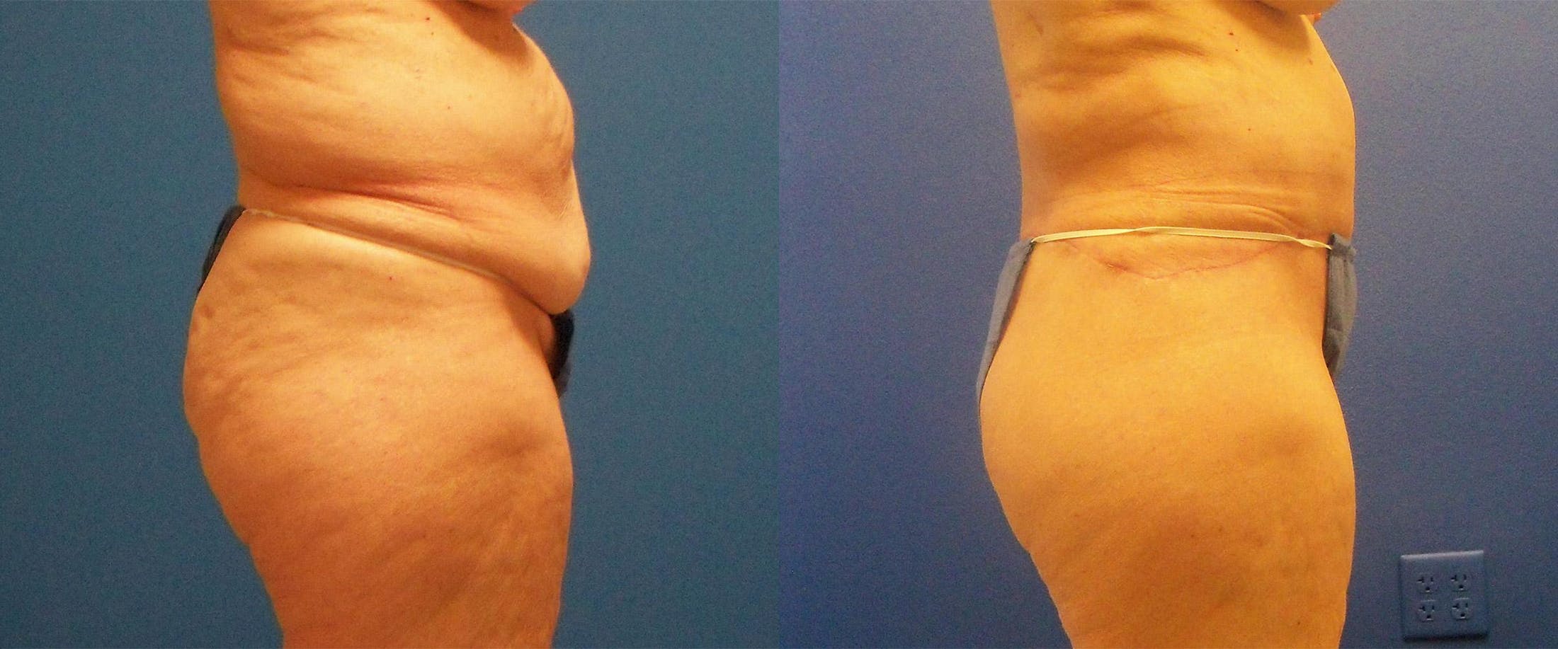 Body Contouring After Weight Loss Before & After Gallery - Patient 122405372 - Image 2