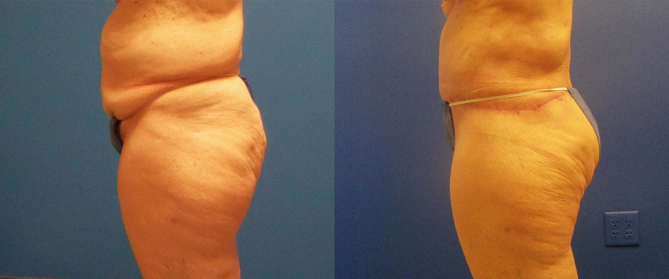 Body Contouring After Weight Loss Before & After Gallery - Patient 122405372 - Image 3