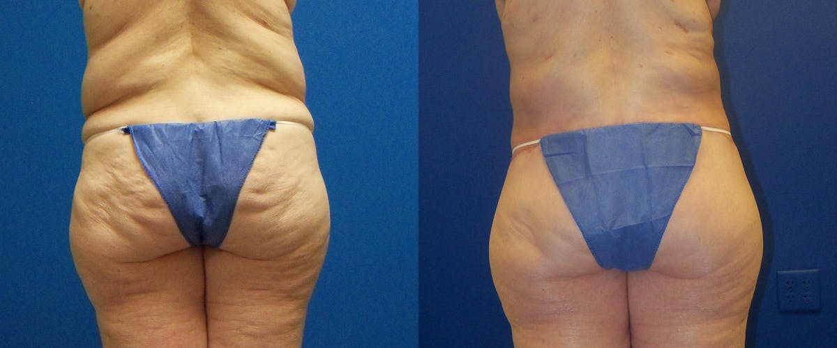 Body Contouring After Weight Loss Before & After Gallery - Patient 122405372 - Image 4