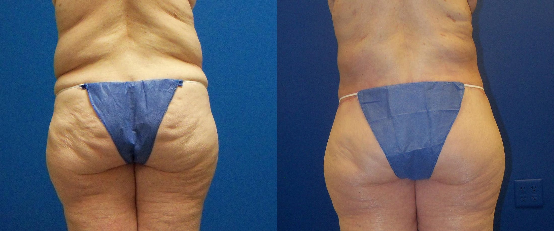 Body Contouring After Weight Loss Before & After Gallery - Patient 122405372 - Image 4