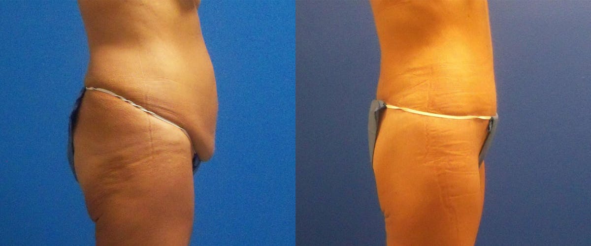 Body Contouring After Weight Loss Before & After Gallery - Patient 122405374 - Image 2
