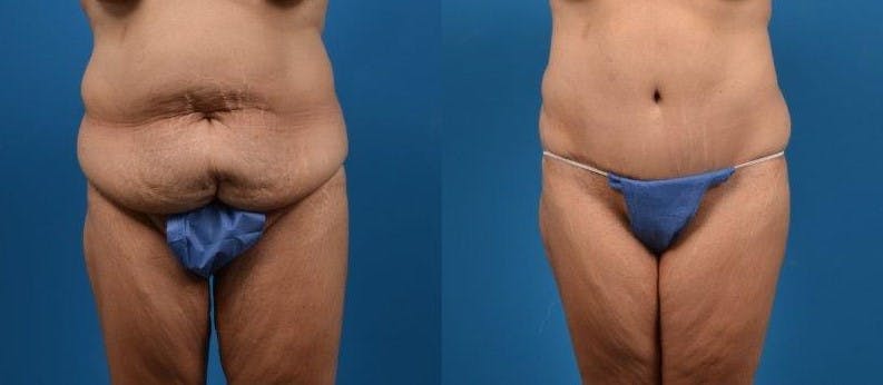 Body Lift Before & After Gallery - Patient 122405373 - Image 1
