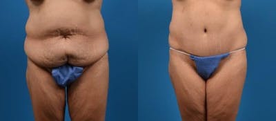 Body Lift Before & After Gallery - Patient 122405373 - Image 1