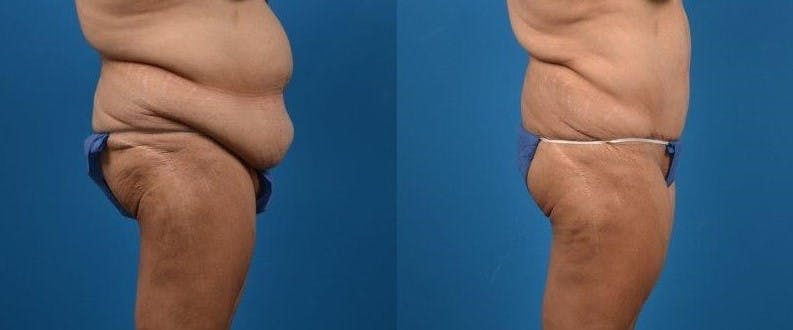 Body Lift Before & After Gallery - Patient 122405373 - Image 2