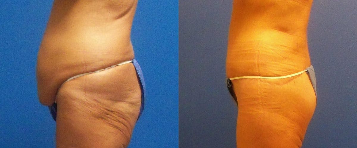 Body Contouring After Weight Loss Before & After Gallery - Patient 122405374 - Image 3