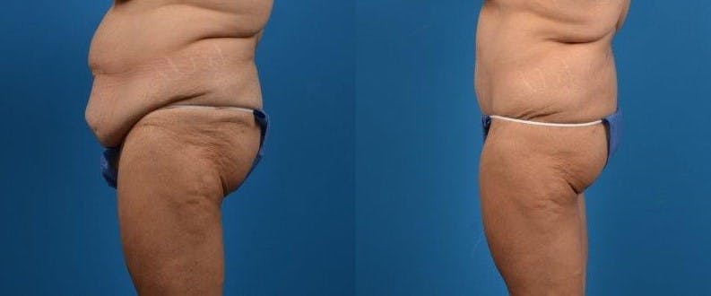 Body Lift Before & After Gallery - Patient 122405373 - Image 3