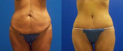 Body Lift Before & After Gallery - Patient 122405382 - Image 1
