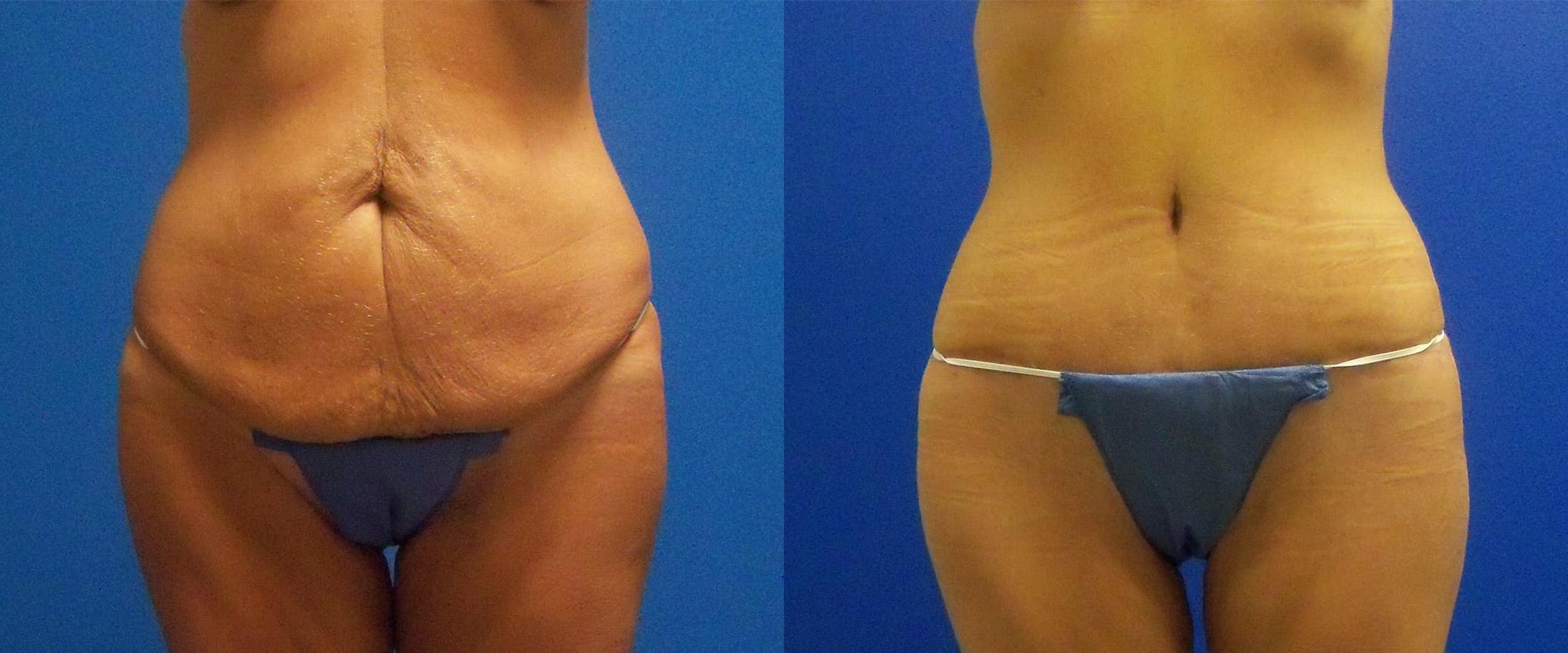 Body Lift Before & After Gallery - Patient 122405382 - Image 1