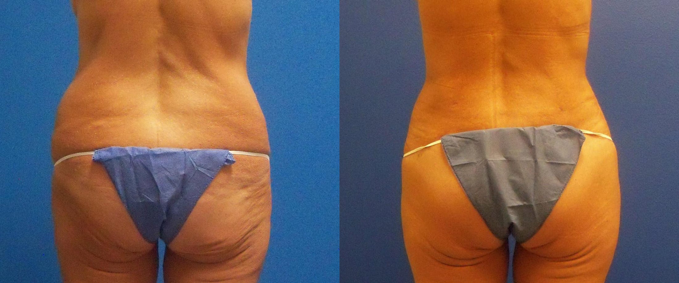 Body Lift Before & After Gallery - Patient 122405382 - Image 4