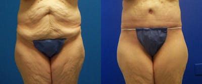 Body Lift Before & After Gallery - Patient 122405383 - Image 1