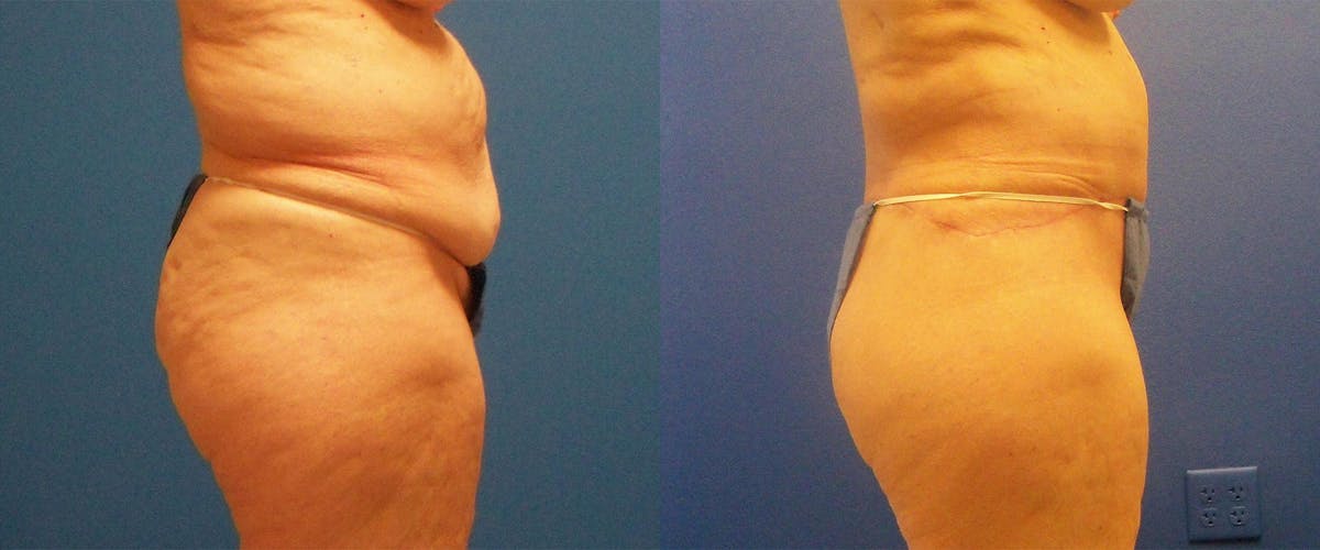 Body Lift Before & After Gallery - Patient 122405383 - Image 2
