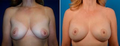 Hidden Breast Aug and Lift Before & After Gallery - Patient 300919 - Image 1
