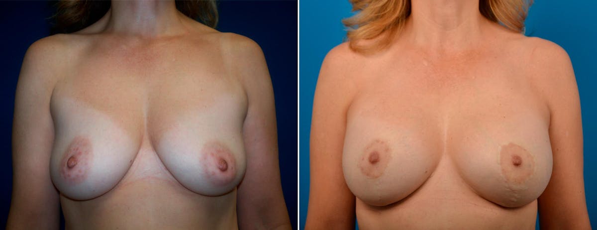 Breast Augmentation and Lift Before & After Gallery - Patient 122010 - Image 1