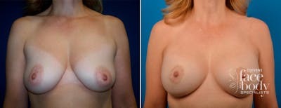 Hidden Breast Aug and Lift Before & After Gallery - Patient 300919 - Image 1