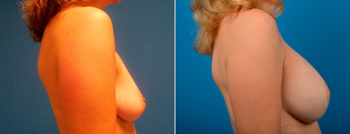 Breast Augmentation and Lift Before & After Gallery - Patient 122010 - Image 2