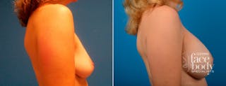 Hidden Breast Aug and Lift Before & After Gallery - Patient 142584 - Image 2