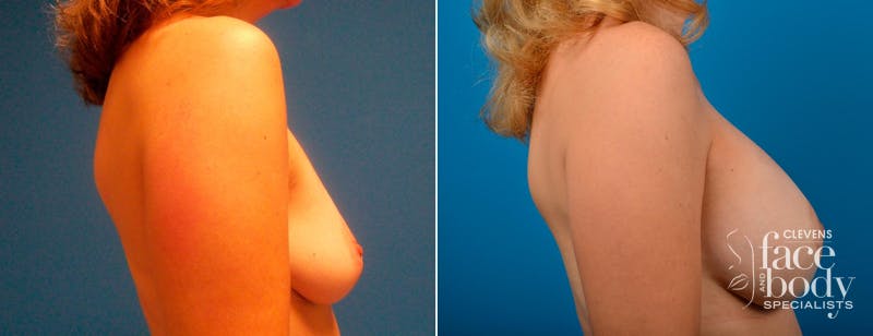 Hidden Breast Aug and Lift Before & After Gallery - Patient 142584 - Image 2