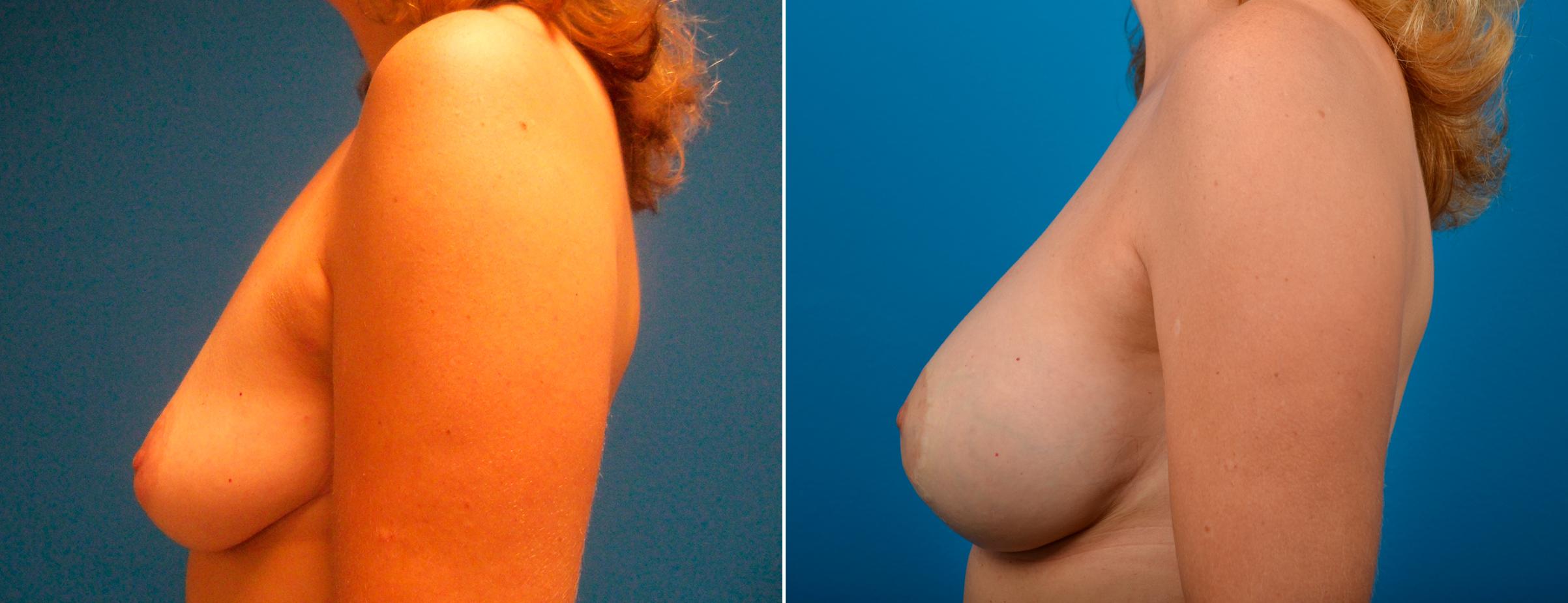 Hidden Breast Aug and Lift Before & After Gallery - Patient 142584 - Image 3