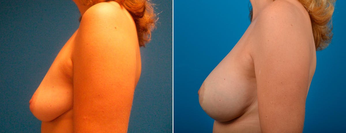 Breast Augmentation and Lift Before & After Gallery - Patient 122010 - Image 3