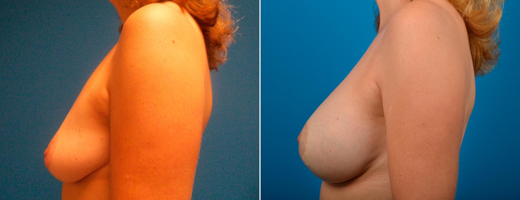 Breast Augmentation and Lift Before & After Gallery - Patient 122405387 - Image 3