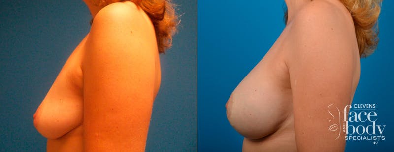 Hidden Breast Aug and Lift Before & After Gallery - Patient 142584 - Image 3