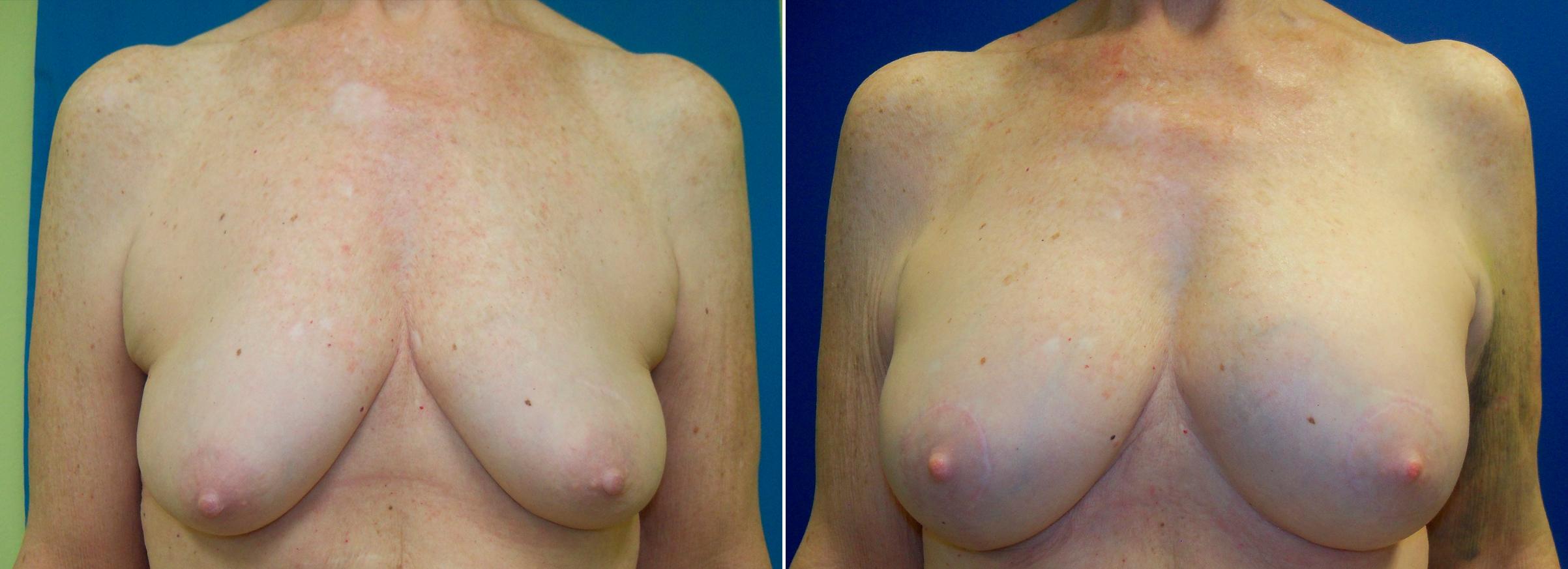 Hidden Breast Aug and Lift Before & After Gallery - Patient 115144 - Image 1
