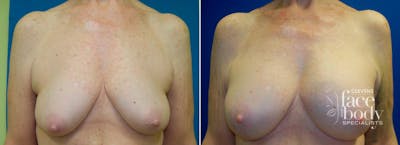 Hidden Breast Aug and Lift Before & After Gallery - Patient 115144 - Image 1
