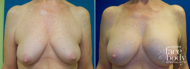 Hidden Breast Aug and Lift Before & After Gallery - Patient 115144 - Image 1