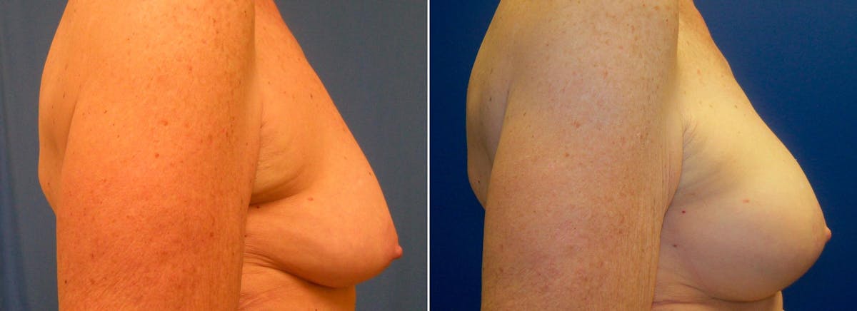 Hidden Breast Aug and Lift Before & After Gallery - Patient 699949 - Image 2